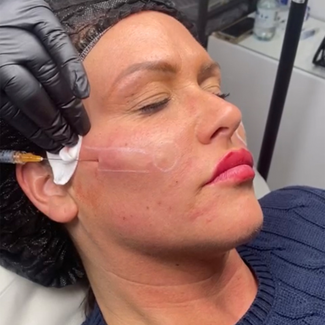 Online Cheeks Masterclass โ FACES Aesthetics and Training